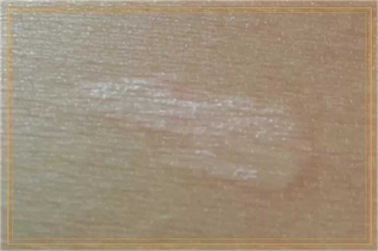 吃什么药白癜风好后不易复发