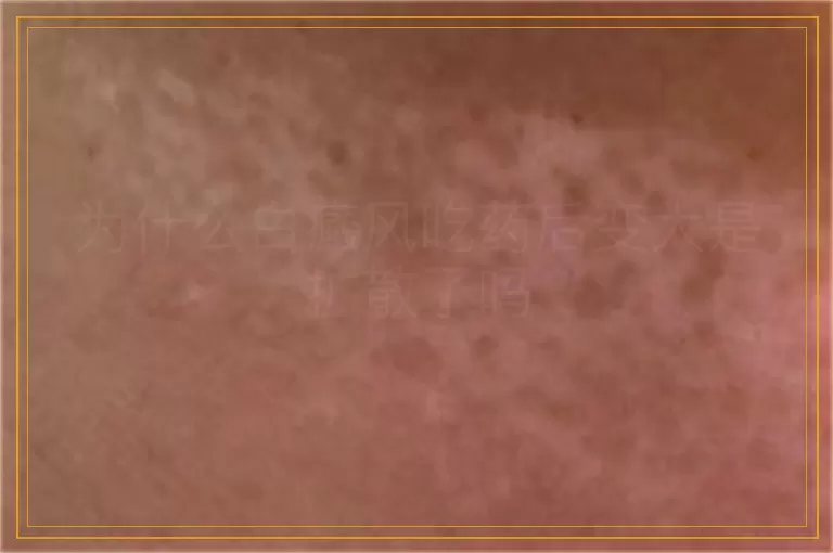为什么白癜风吃药后变大是扩散了吗