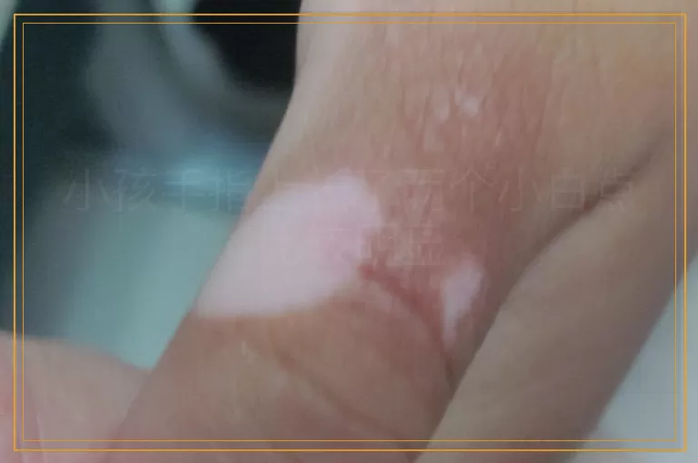 小孩手指上长了两个小白点比较明显