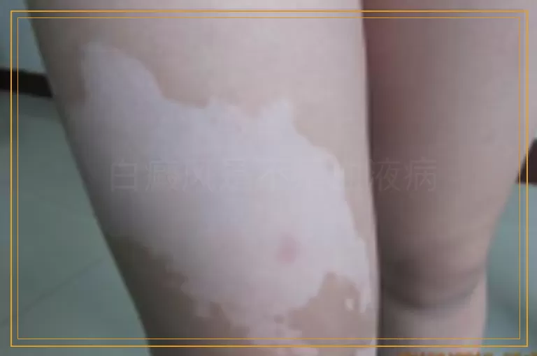 白癜风是不是血液病