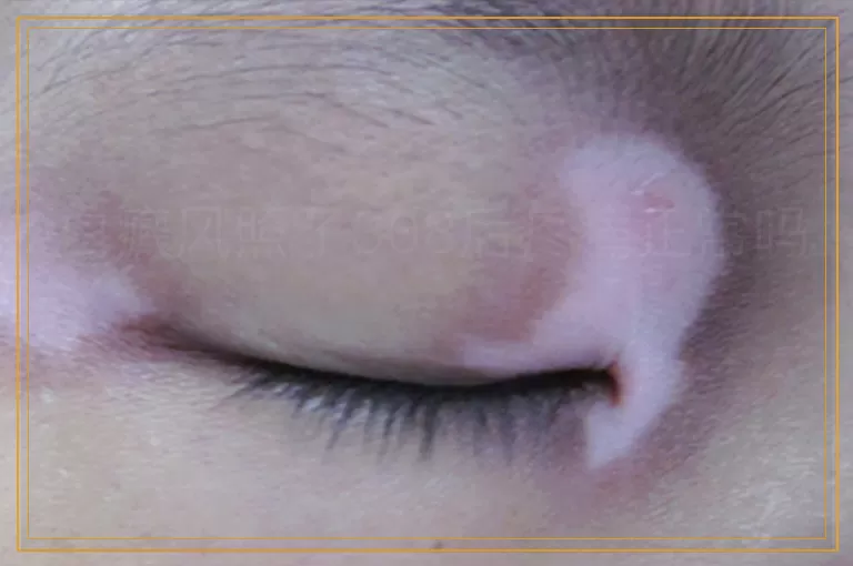 白癜风照了308后疼痛正常吗