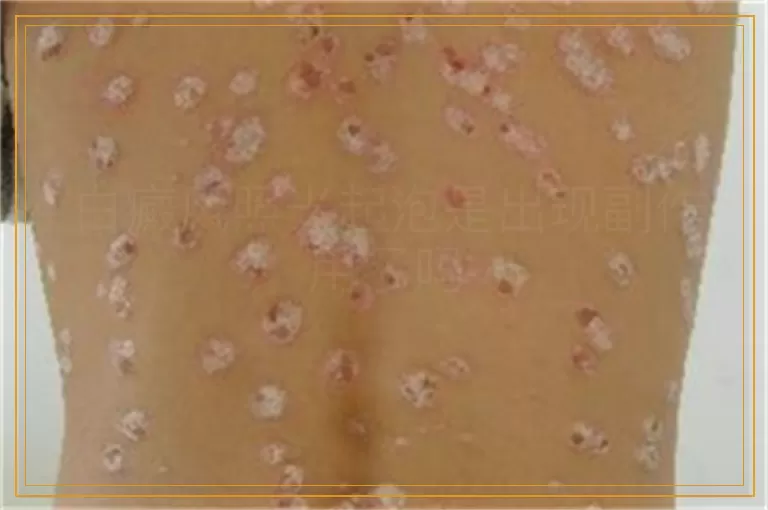 白癜风照光起泡是出现副作用了吗
