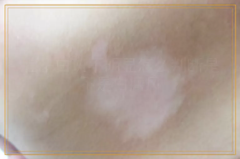 肚子白斑不明显怎么判断是不是白癜风