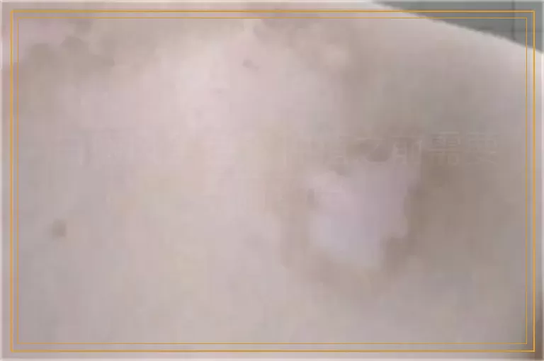 白癜风黑色素种植之前需要打麻药吗