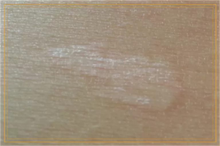 308nm准分子激光治疗白癜风一周照射几次效果比较好