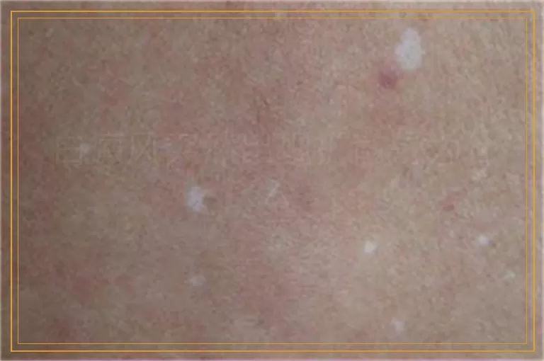 白癜风突然出现扩散是为什么