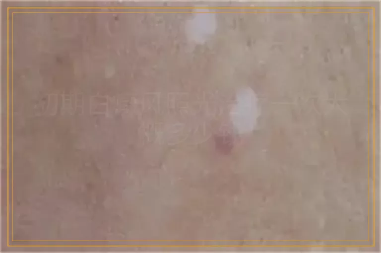 初期白癜风照光治疗一次大概多少钱