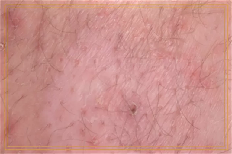 伍德灯照白斑是白癜风有什么症状