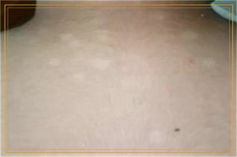 腿上白斑刚检查出是白癜风怎么治效果好