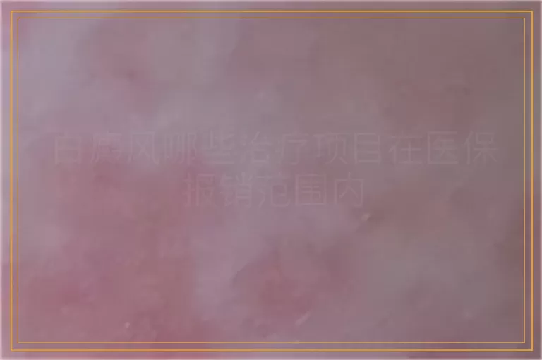 白癜风哪些治疗项目在医保报销范围内