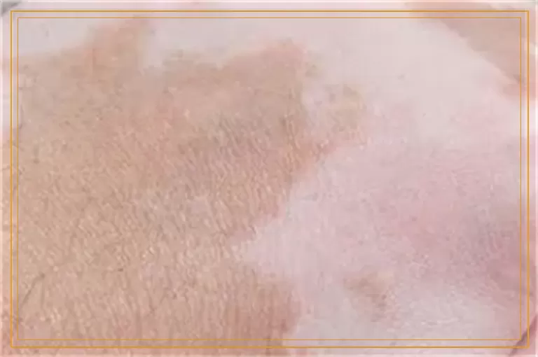 白癜风做308治疗后出好多水泡怎么回事