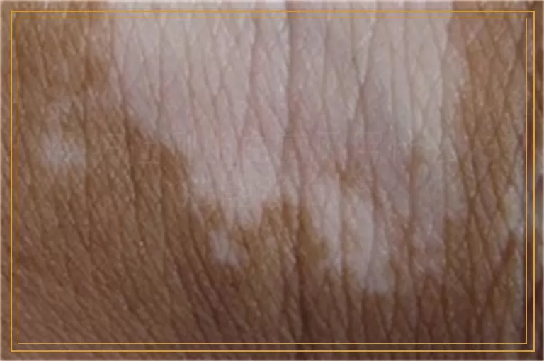 孕妇检测出白癜风用什么方法能够治好