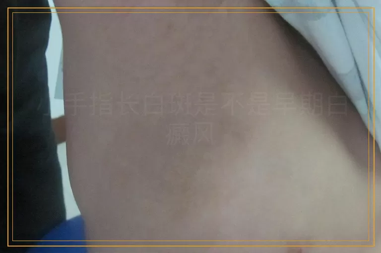 小手指长白斑是不是早期白癜风