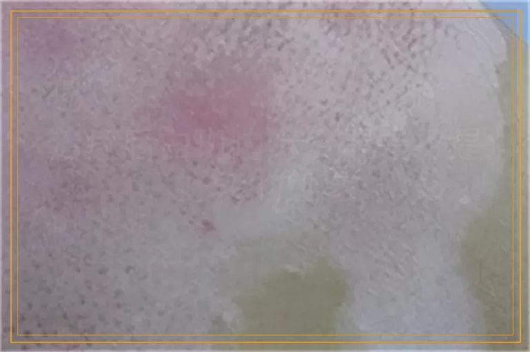 治疗后白斑边缘变黑是不是好转的迹象