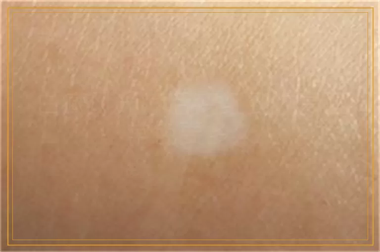 白癜风光疗后变红到恢复正常色要多久