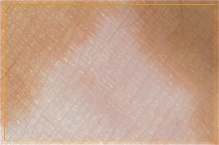 中西结合治白癜风的方法有哪些