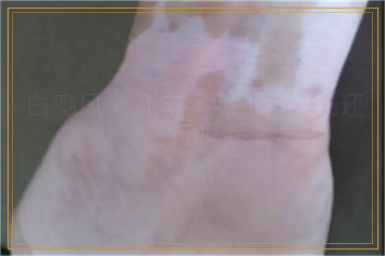 白癜风十几年了照308激光还行吗