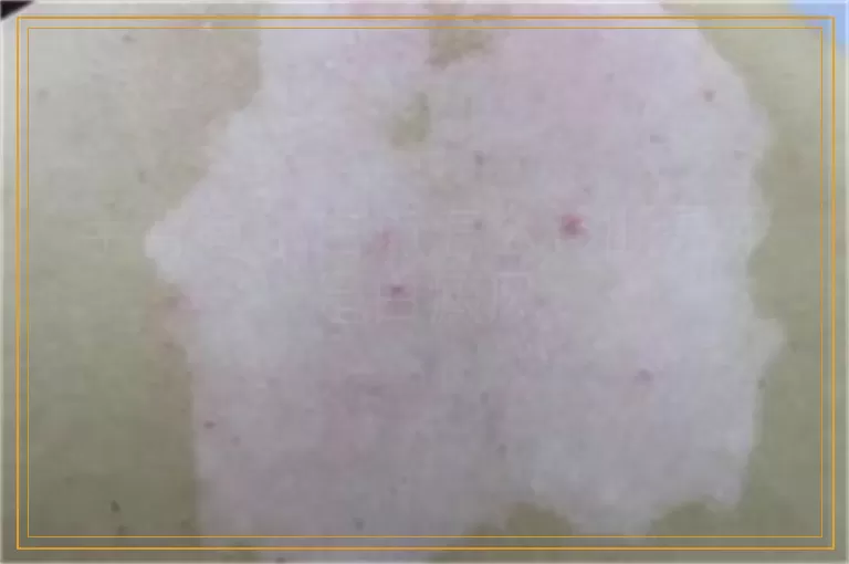 手背有小白点怎么诊断是不是白癜风