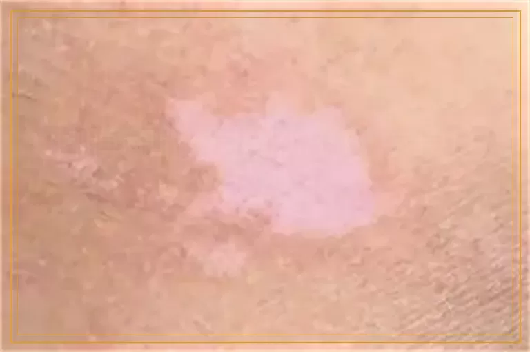 胳膊和腿上皮肤出现白块咋回事