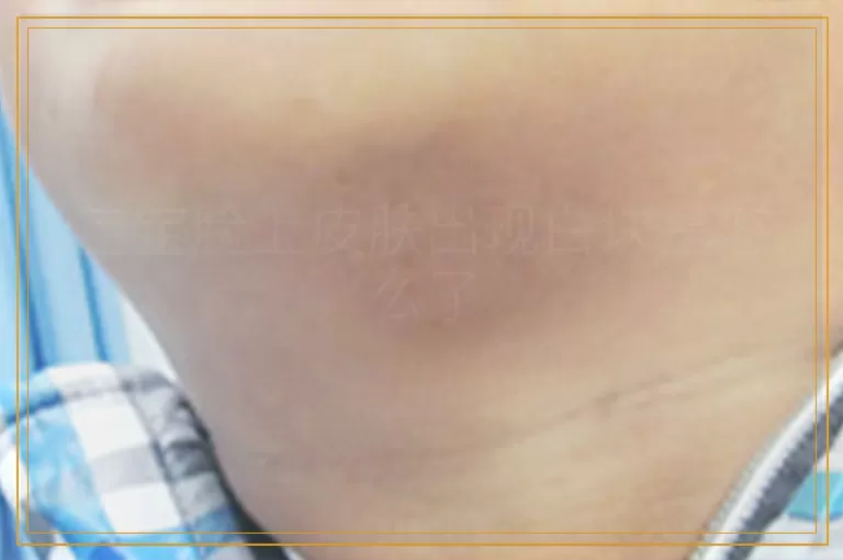 宝宝脸上皮肤出现白块是怎么了