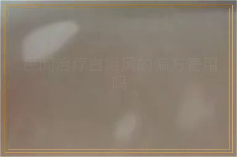 民间治疗白癜风的偏方管用吗