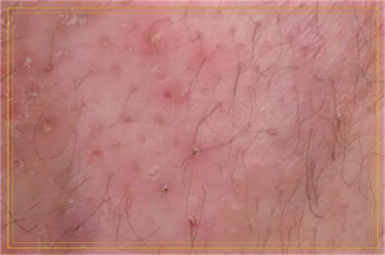 照308激光对孩子发展期白癜风效果怎么样