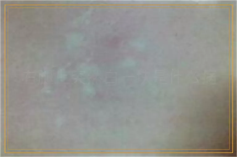 右腿上突然白一块是什么病