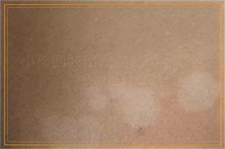 小孩四肢出现白色斑点如何判断是什么