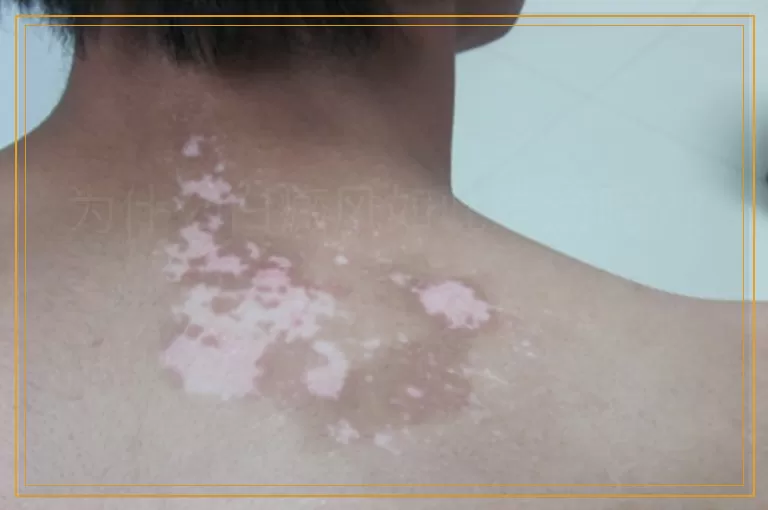 为什么白癜风如此难治呢??