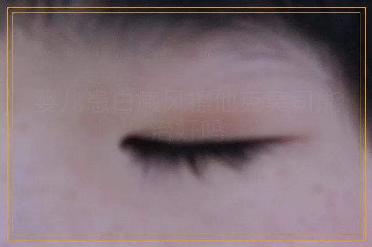 婴儿患白癜风擦他克莫司能治好吗