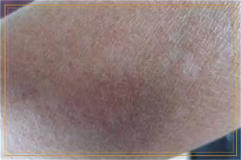 为什么孩子脸上突然长了白点