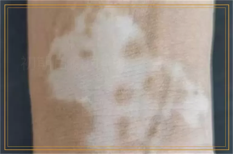 初期白癜风照射准分子激光多少次能好