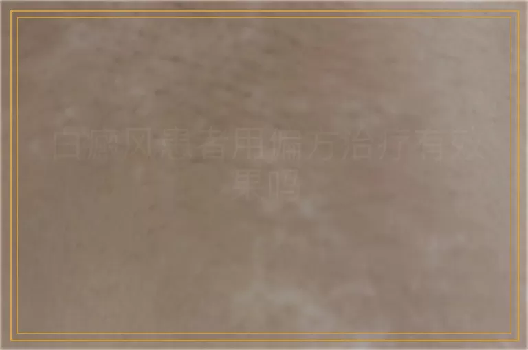 白癜风患者用偏方治疗有效果吗