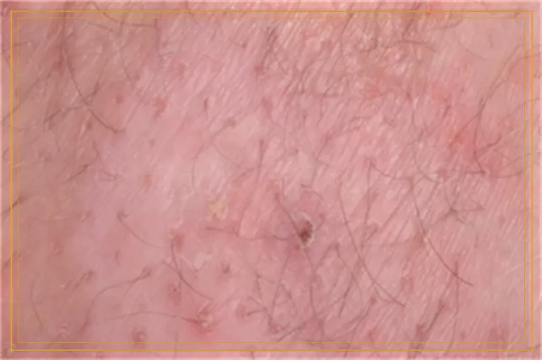 308激光治疗白斑复发吗