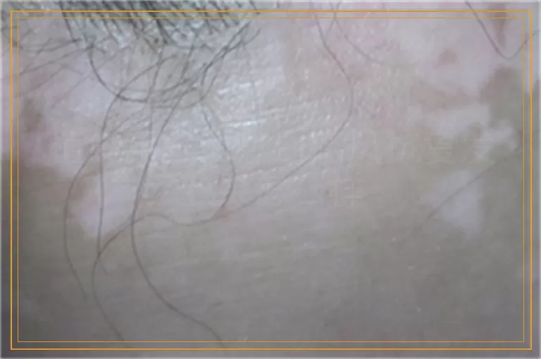 植皮手术治疗白癜风抗复发效果怎么样