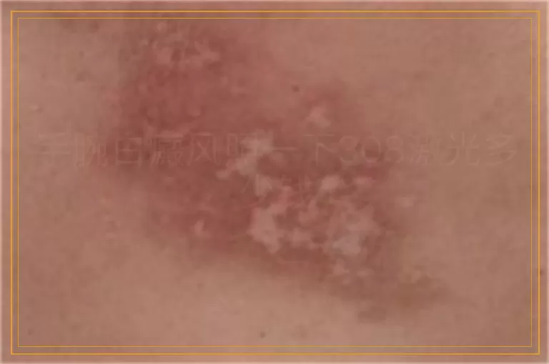 手腕白癜风照一下308激光多少钱