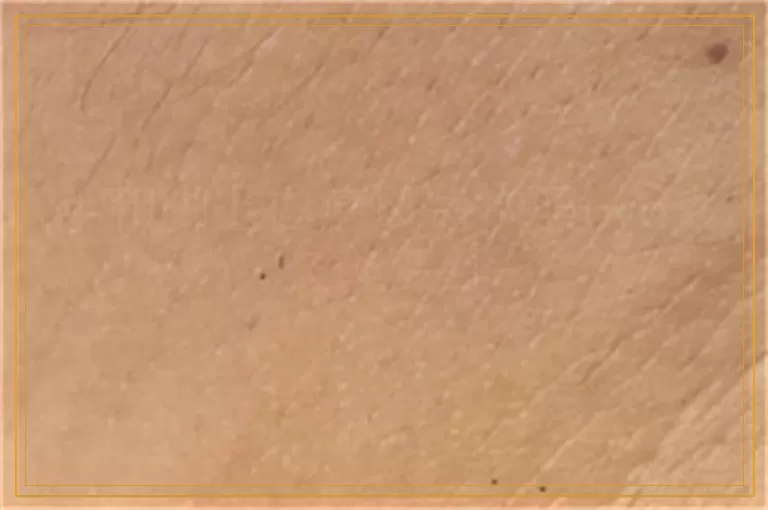 手和脚上白癜风每次照uvb多久能变红