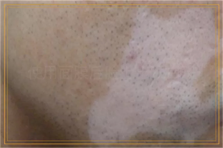 使用面膜后脸上出现白斑