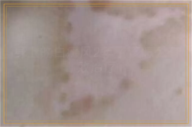 身上的白癜风2年了该怎么有效治疗