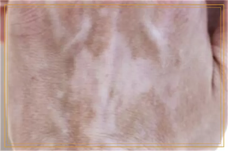 老人手上出现了白癜风该怎么治