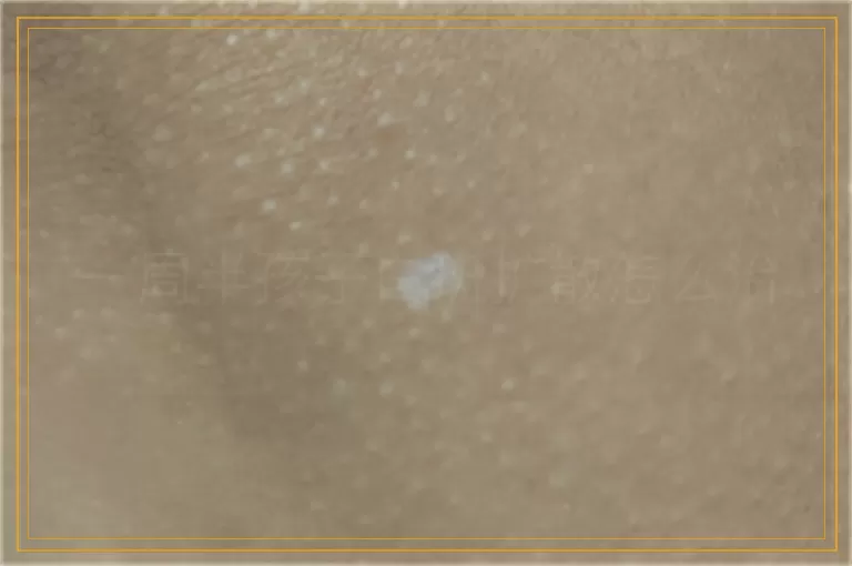 一周半孩子白斑扩散怎么治