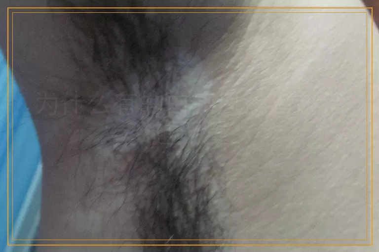 为什么有的白癜风患者越治越严重