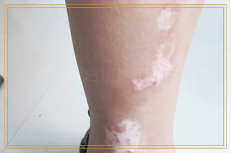 小腿出现白斑是不是白癜风