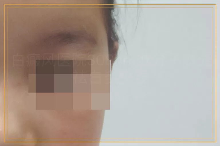 白癜风医院308nm准分子激光祛白多少钱