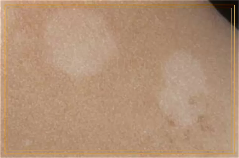 脸上突然出现几个小白块是什么病