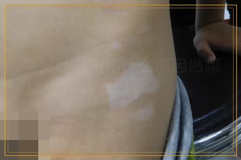 手指肚发白是什么原因做哪些检查