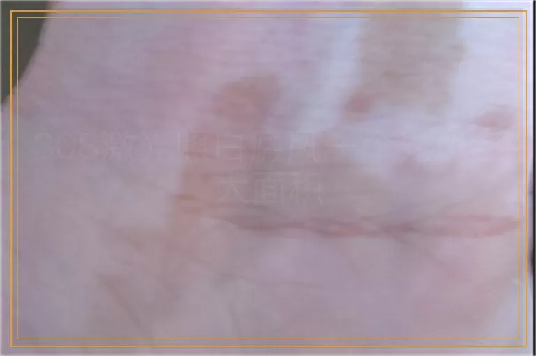 308激光照白癜风一个光斑多大面积