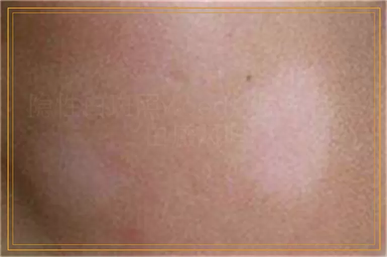 隐性白斑照wood灯显白色是白癜风吗