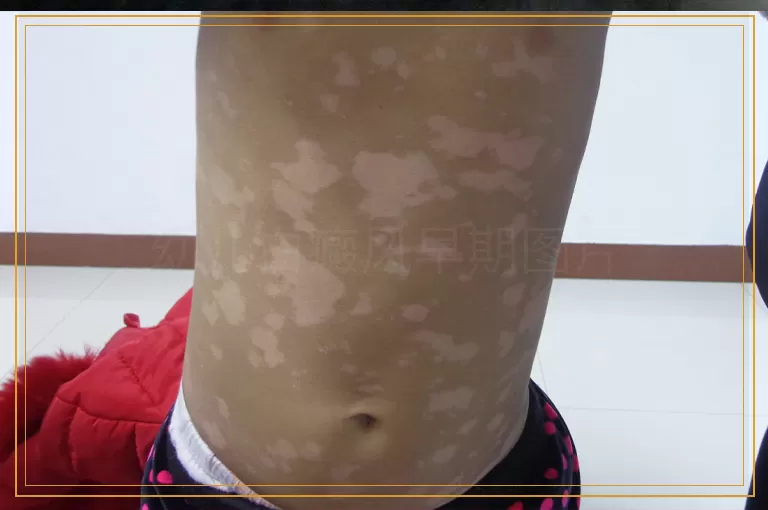 幼儿白癜风早期图片