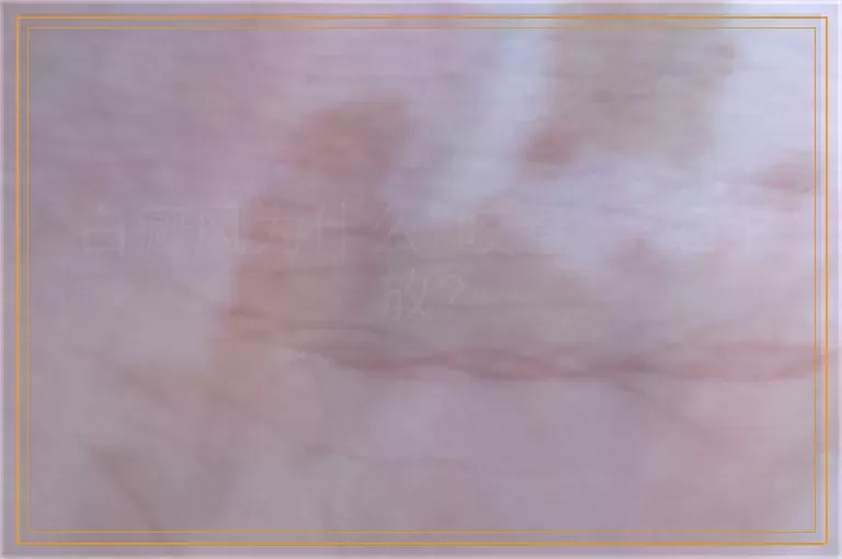 白癜风为什么“咬着”孕妇不放?